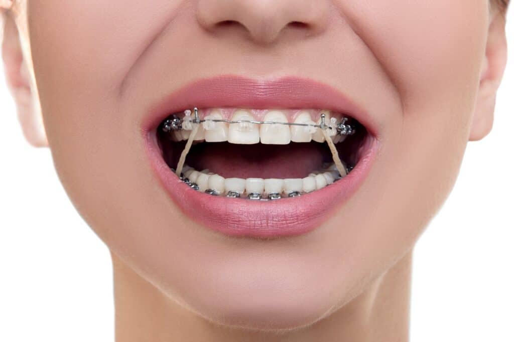 how-long-will-i-need-to-wear-braces-east-houston-baytown